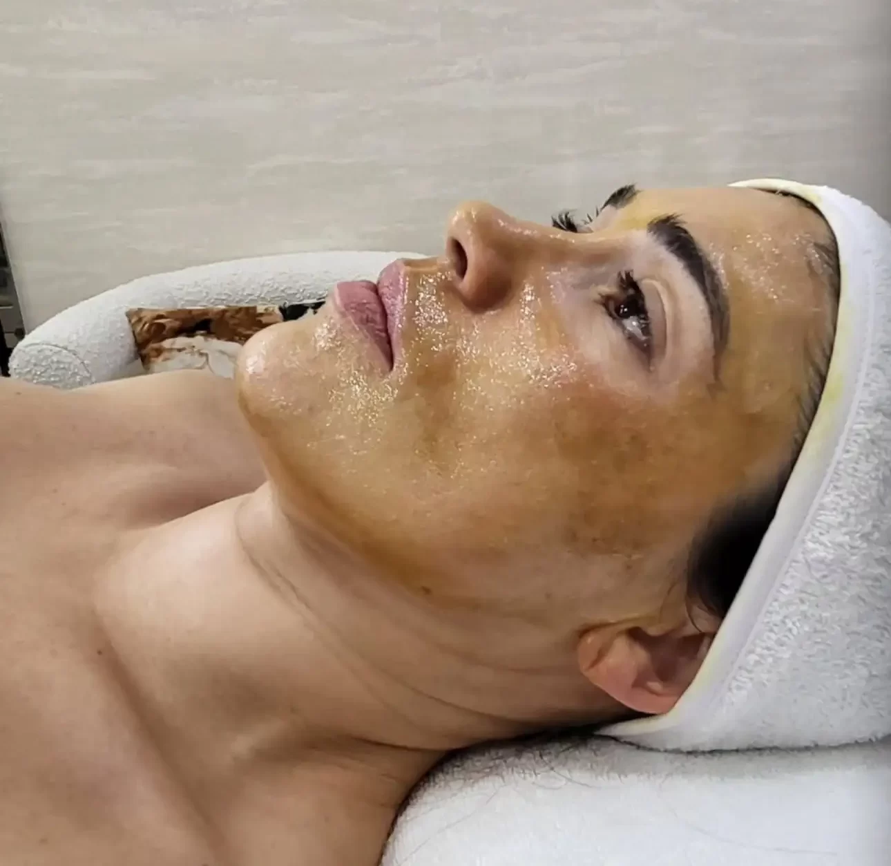 Mulher a receber tratamento de peeling facial para renovação da pele.